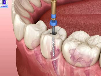 Endodoncia en San Sebastián de los Reyes